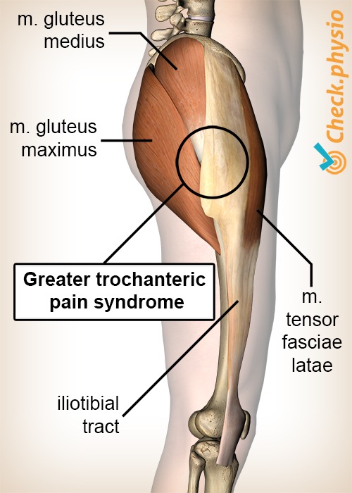 Greater trochanter pain syndrome