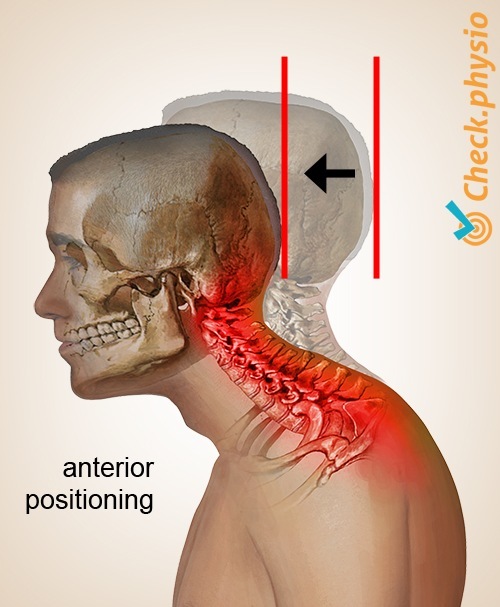 Poor Posture: The Main Culprit Behind Muscle Tension - In Touch