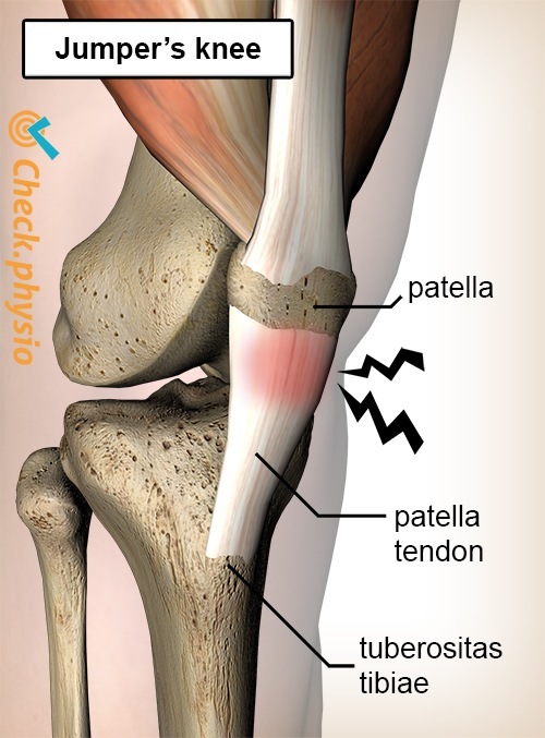 https://www.physiocheck.co.uk/images/artikelen/136/knee-jumpers-knee-pain-patella-tendon-tendinitis.jpg
