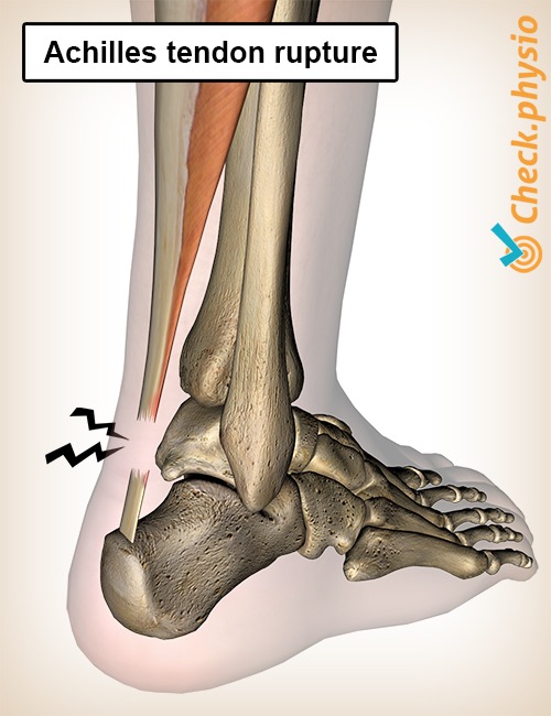 https://www.physiocheck.co.uk/images/artikelen/178/lower-leg-achilles-tendon-rupture.jpg