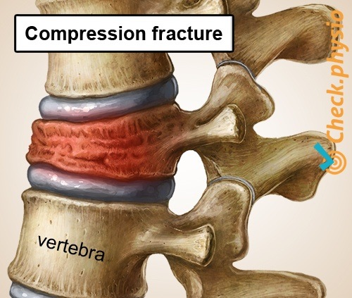 https://www.physiocheck.co.uk/images/artikelen/219/back-specific-low-back-pain-collapsed-vertebra.jpg