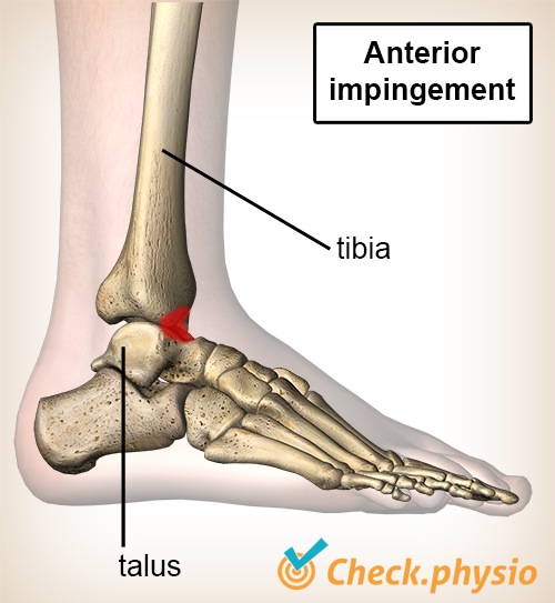 https://www.physiocheck.co.uk/images/artikelen/43/ankle-anterior-impingement.jpg