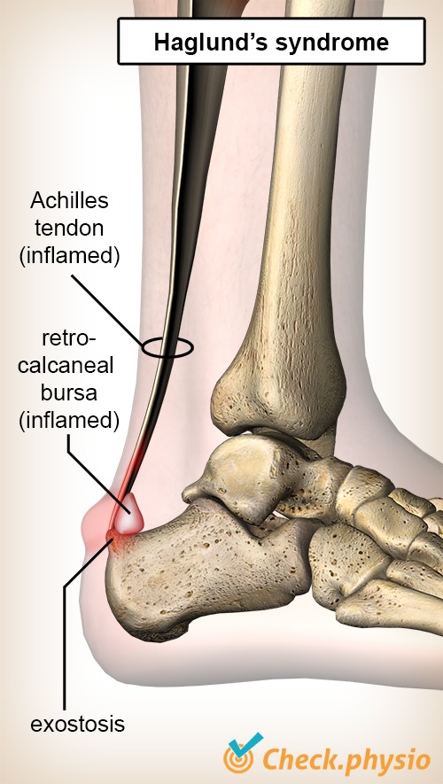 Rehab Achilles Tendinopathy - [P]rehab