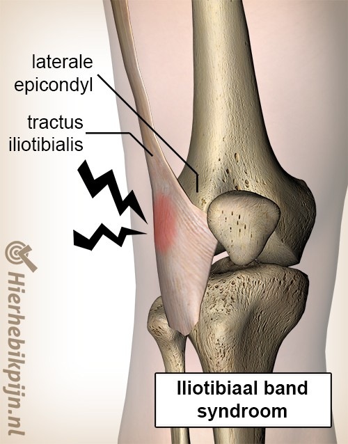 Iliotibial Band Syndrome: Anatomy & Symptoms Of The Most Common Running  Injury — Revive Sport & Spine