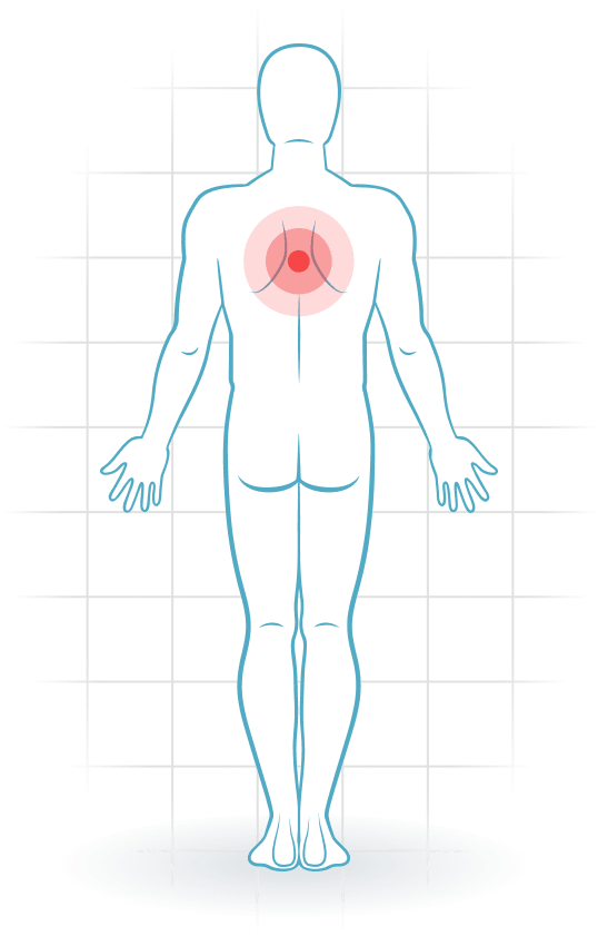 pijnlocatie Scheuermann's disease