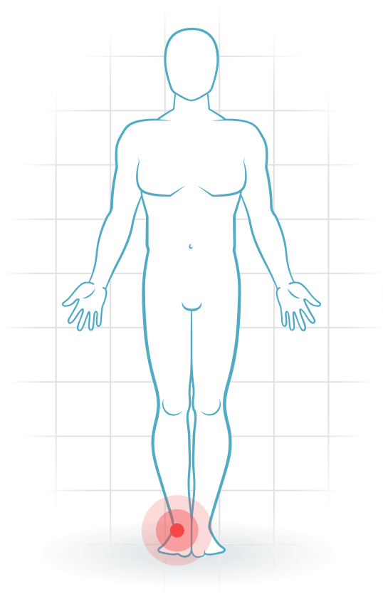 pijnlocatie Sinus tarsi syndrome