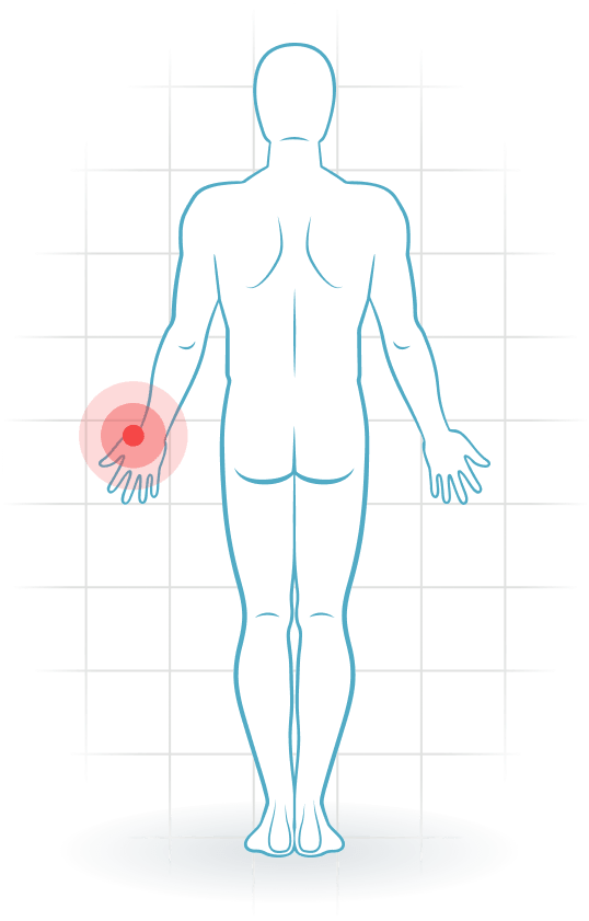 pijnlocatie Base of thumb arthritis