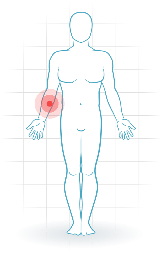 pijnlocatie Pronator teres syndrome