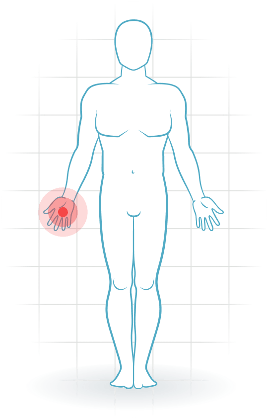 pijnlocatie Osteoarthrosis of the hand