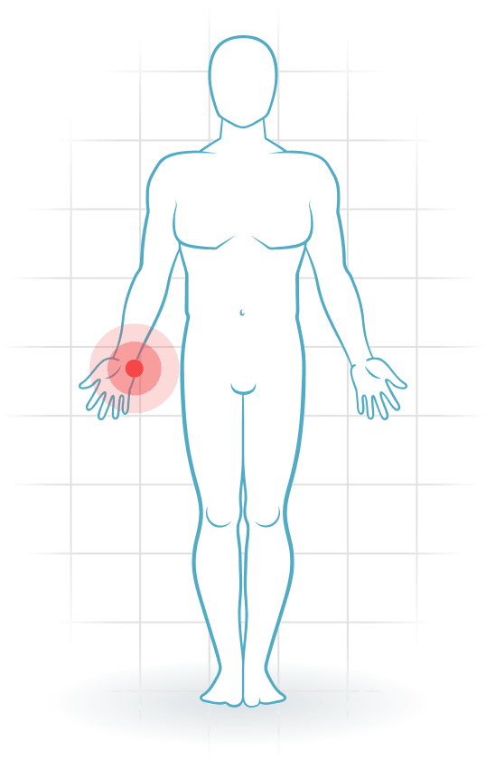 pijnlocatie TFCC injury