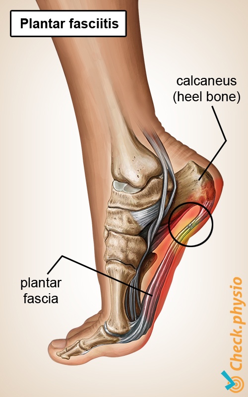 calcaneal spur physiotherapy