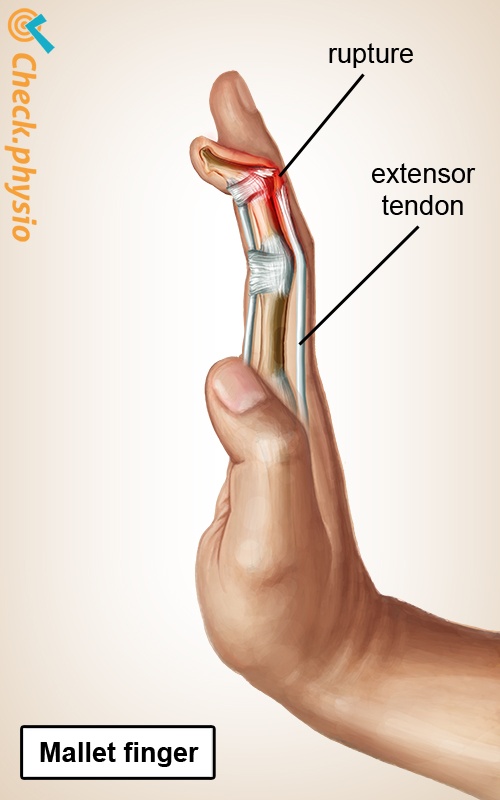 Mallet Finger Physio Check