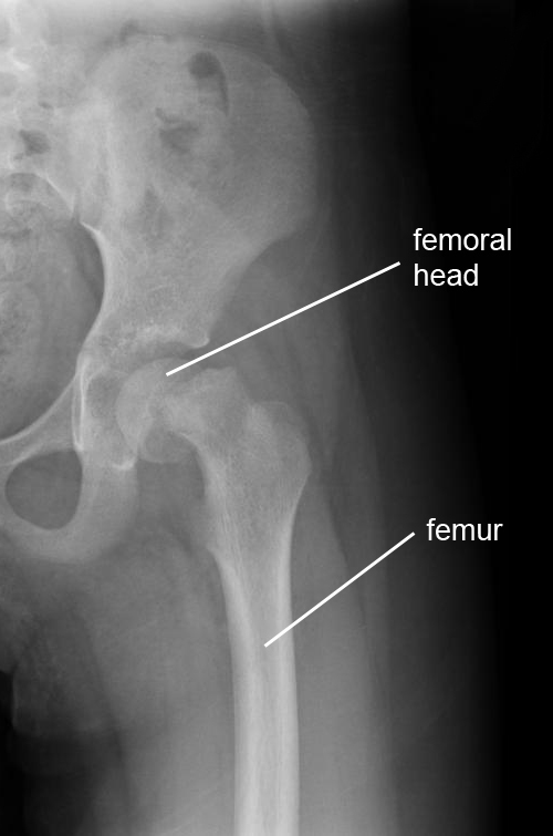 Slipped capital femoral epiphysis | Physio Check