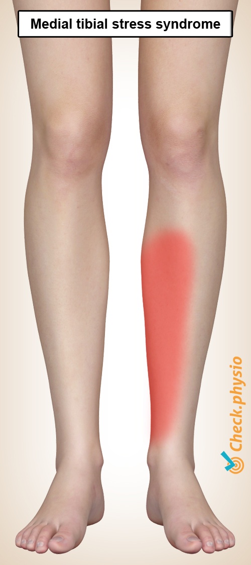 Medial Tibial Stress Syndrome Physio Check