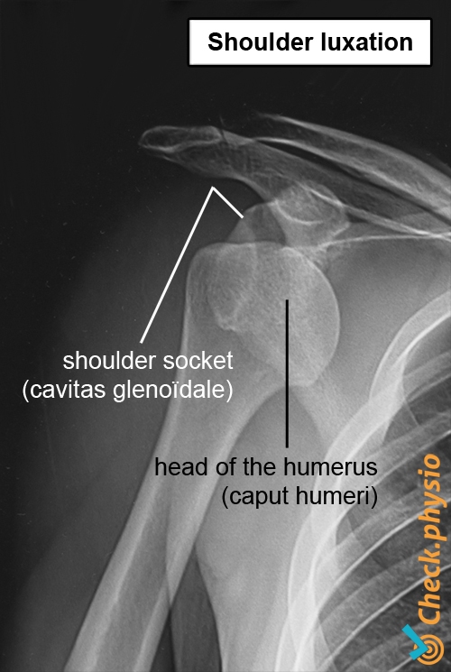 X Ray Shoulder Dislocation