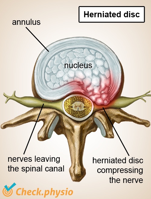 Lumbosacral radicular syndrome | Physio Check