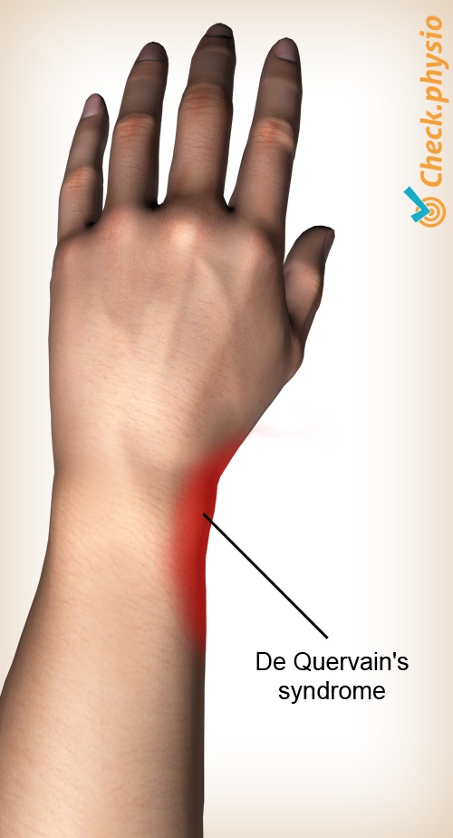 De Quervain's syndrome Physio Check